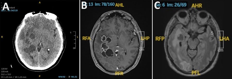 Homem na Espanha é diagnosticado com vermes após suspeita de câncer cerebral