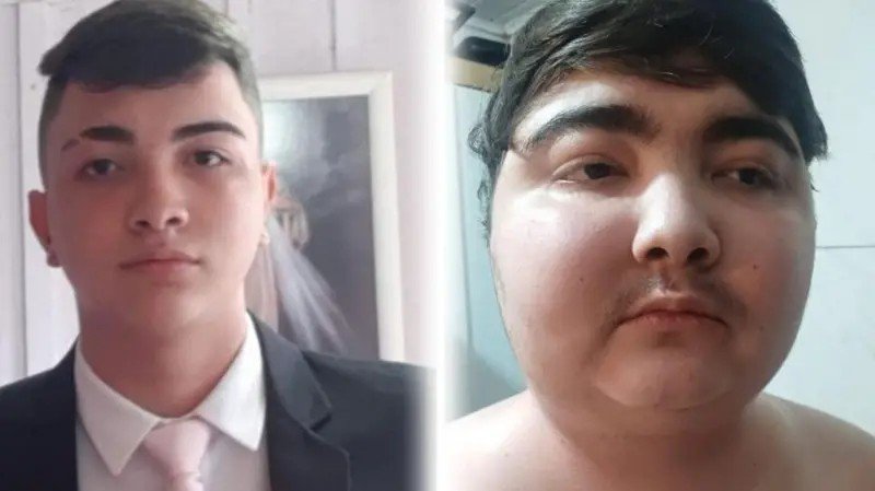 Tumor benigno faz adolescente ganhar 40 quilos em seis meses