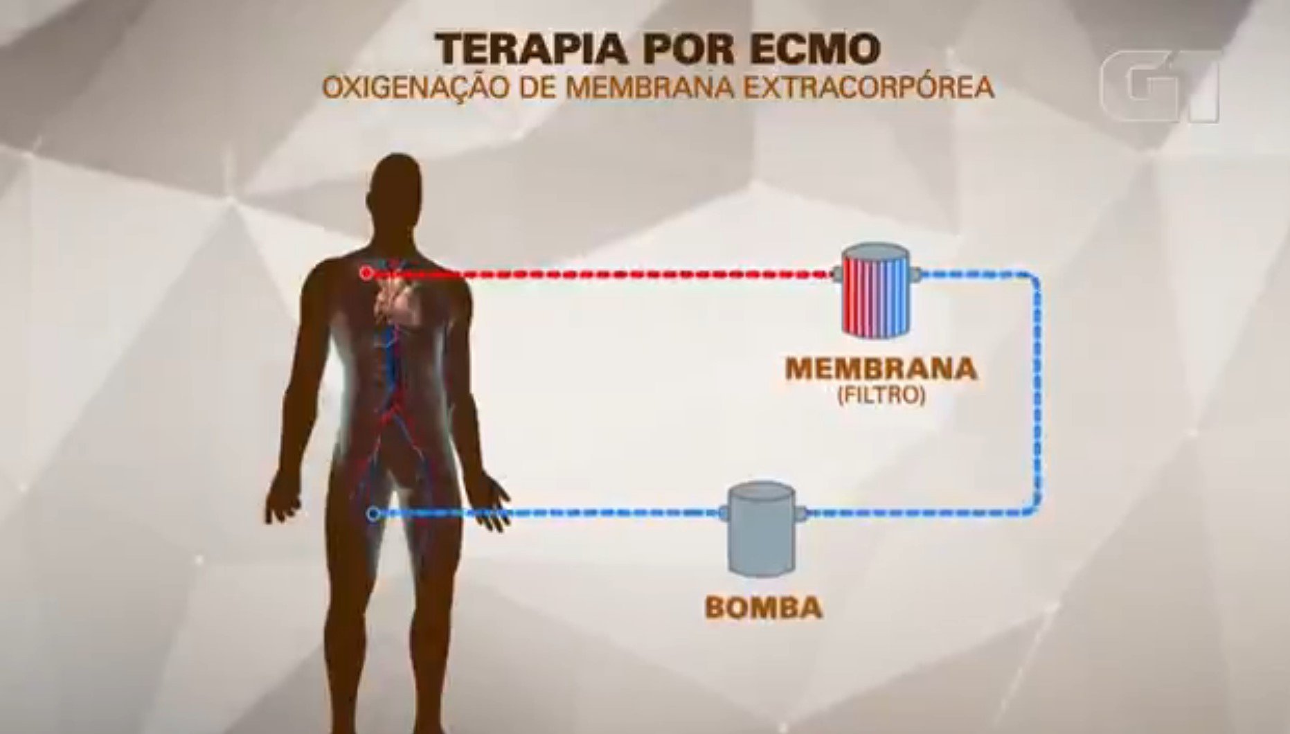 MC Marcinho é submetido a terapia ECMO após parada cardiorrespiratória