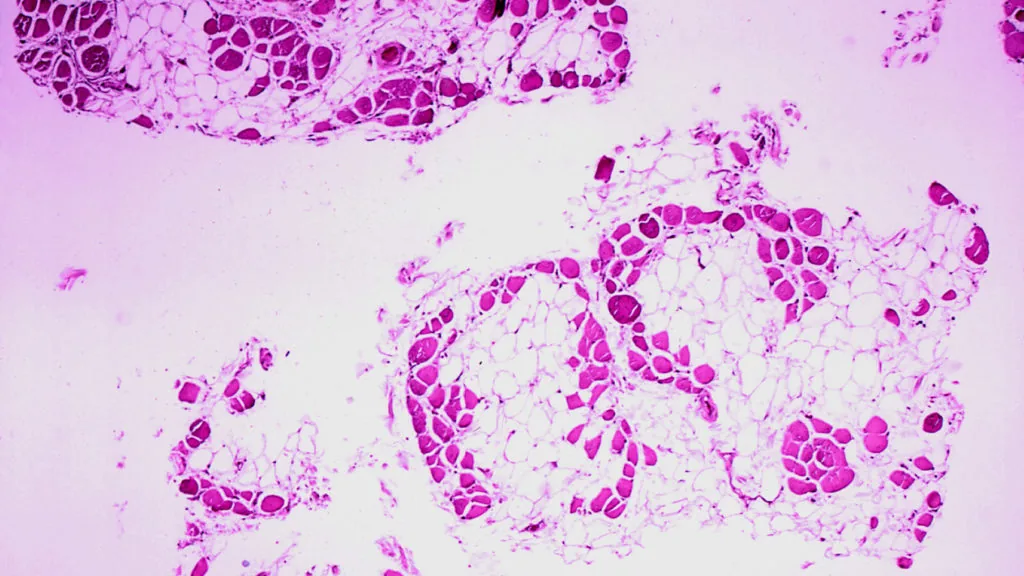 Comitê de especialistas da FDA analisa terapia para distrofia muscular de Duchenne da Capricor Therapeutics