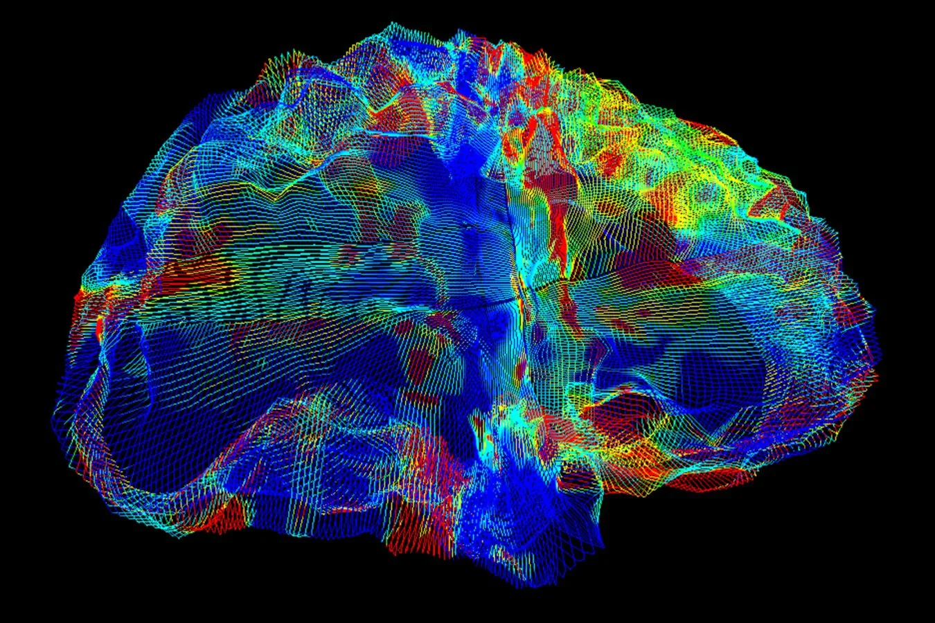 Novo medicamento para Alzheimer reduz risco de hemorragias cerebrais