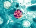Crescem os casos de ciclospora nos EUA, com surto histórico em Michigan