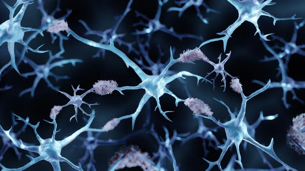 Resultados preliminares de ensaio clínico indicam tratamento mais seguro para Alzheimer