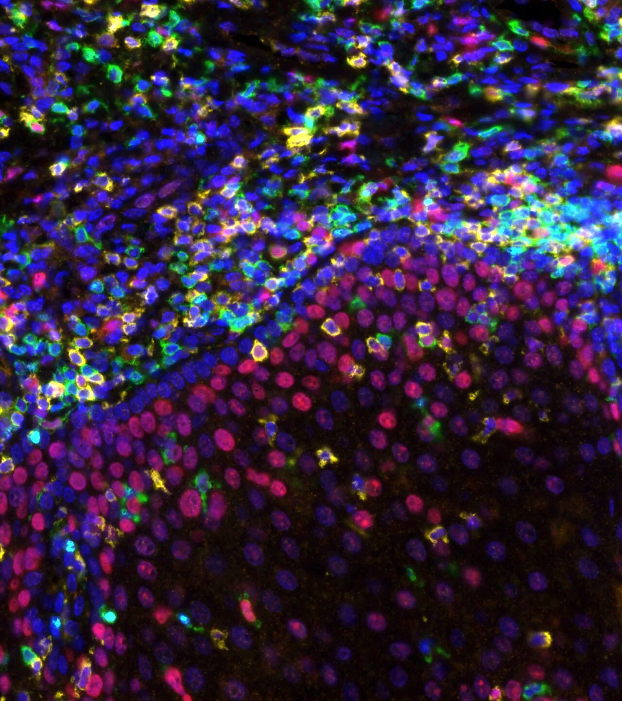 Imunoterapia antes da cirurgia pode oferecer proteção duradoura contra câncer colorretal