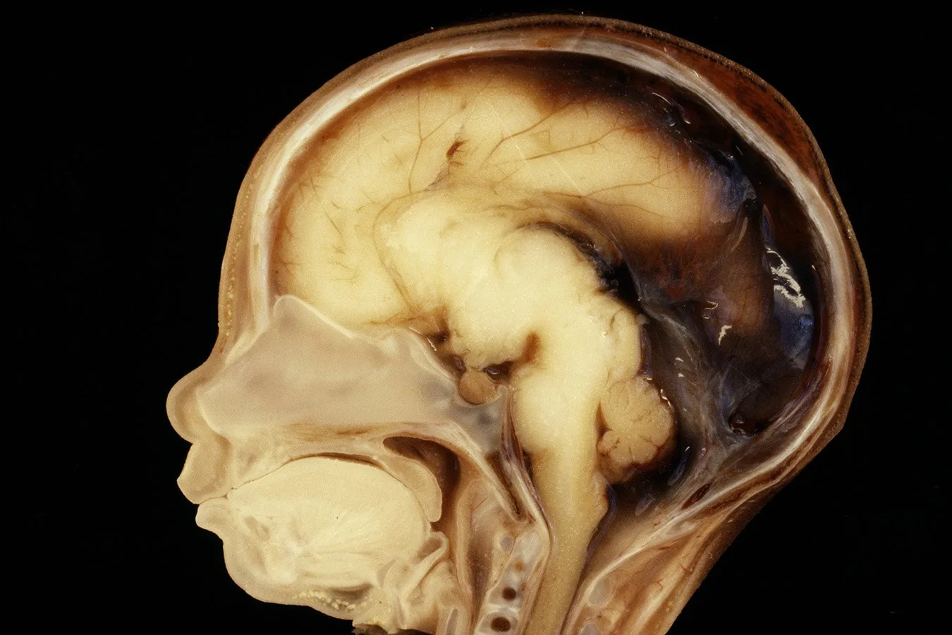 Descobertas sobre células microciméricas no cérebro