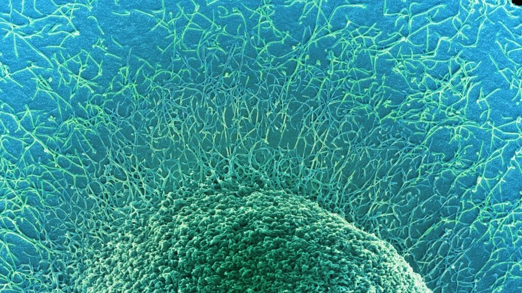 Novo atlas de tumores colônicas revela diferenças entre cânceres em pessoas jovens e idosas