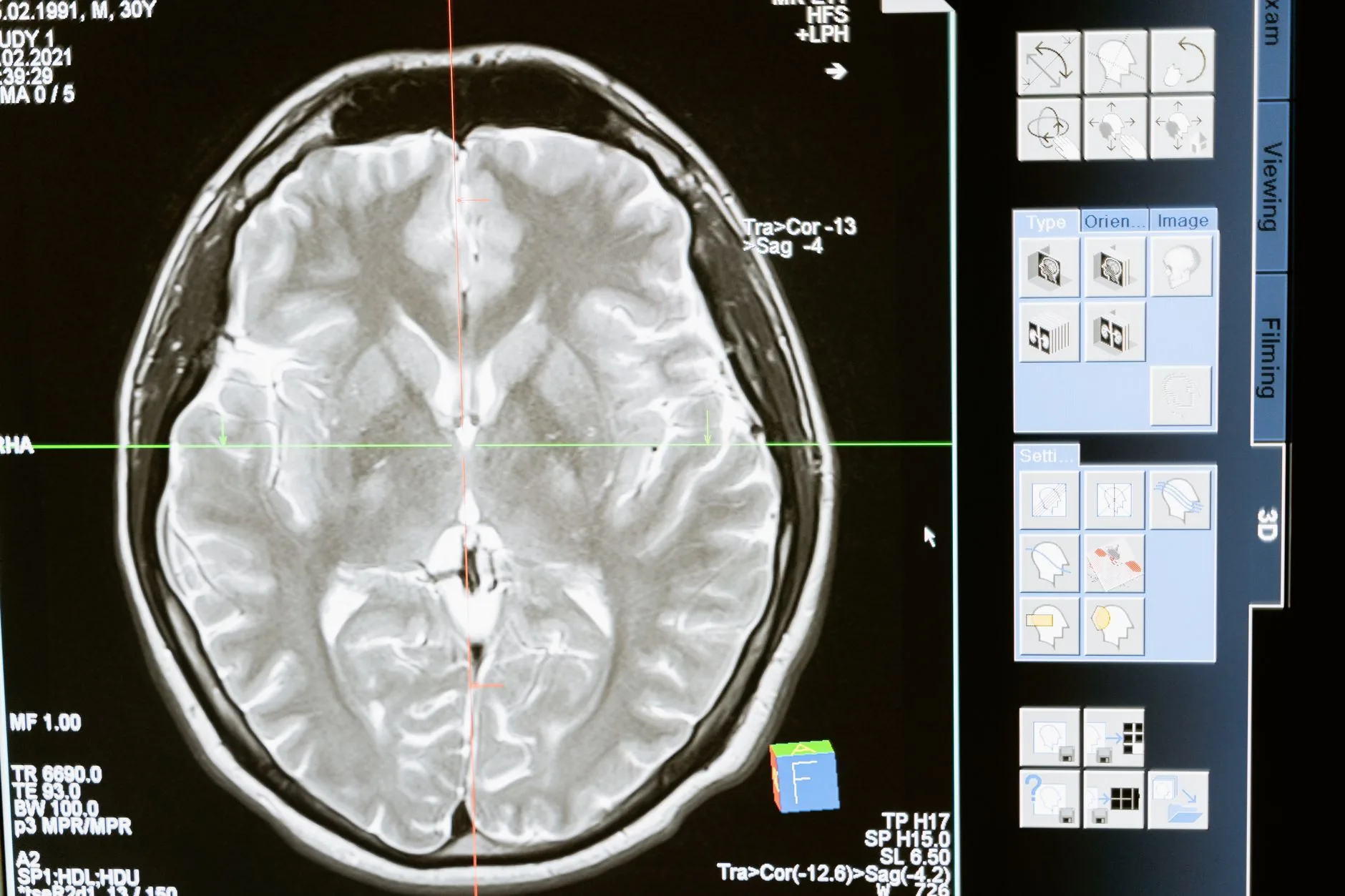Receptor pode bloquear inflamação cerebral associada a Alzheimer e Parkinson