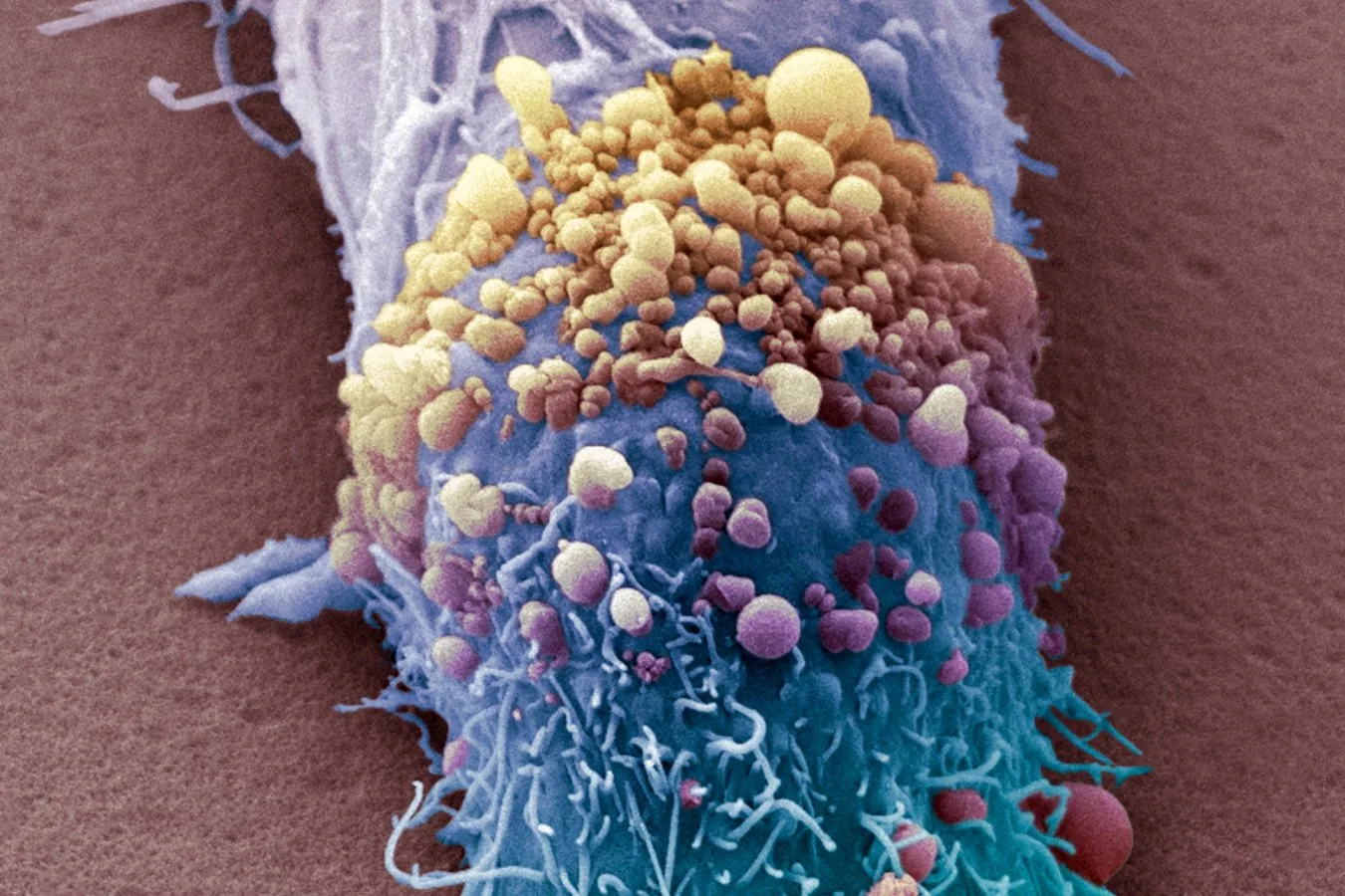 Vacina personalizada contra melanoma pode ser aprovada no próximo ano